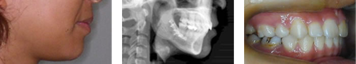 治療の手順　骨格性上顎前突（下顎後退）